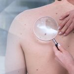 Netratat, melanomul malign produce moartea in 6-18 luni de la aparitie