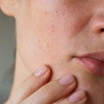 Tratamente pentru ten mixt cu pori dilatati