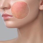 Pete pe fata? Poate ai probleme cu rozaceea