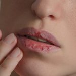 Tot ce trebuie sa stii despre buzele uscate