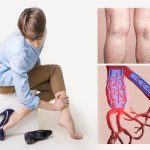 Tratamente pentru vene varicoase